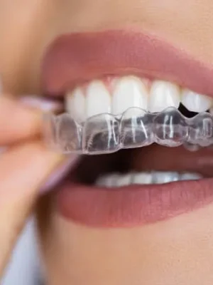 imgi_1_clear-aligner-dental-night-guard